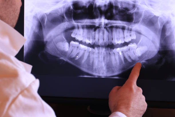 Best Emergency Wisdom Teeth Removal in Jones, OK
